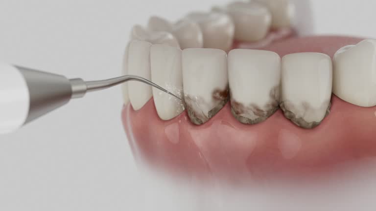 Trusted Wisdom Tooth Removal service in Ocoee, FL - Dentist Open Now